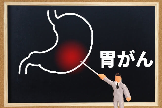胃がんの原因、胃がん予防になる食生活改善