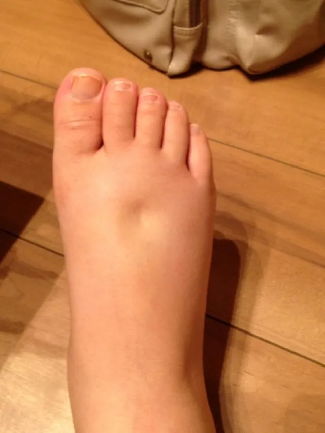 足のむくみがひどく、指で押した跡がなかなか消えない状態の写真