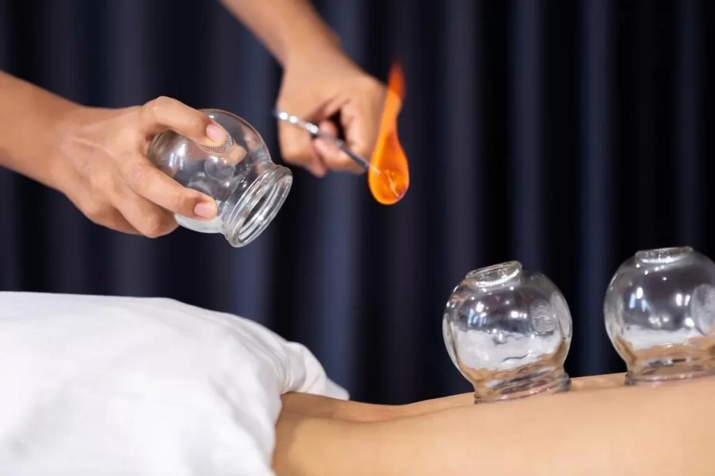 施術者がピンセットで火のついた綿棒を持ち、透明な吸玉を患者の背中に置こうとする様子。背中にはすでに複数の吸玉が付着し、カッピング療法の施術中を表す。