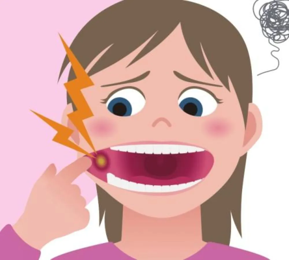 f:id:li-hari:20180704175840j:plain 口内炎で舌が痛む女性のイラスト。口を開けて黄色い潰瘍が見え、頭の周りにストレスを表すモヤモヤした線が渦巻いている漫画風イラスト
