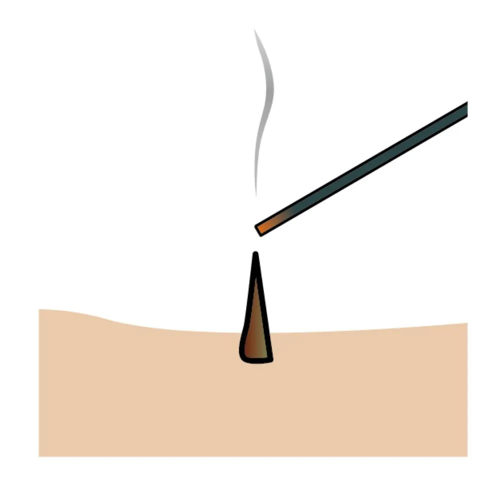 お灸（円錐形もぐさ）を皮膚に置き線香で点火するアニメイラスト