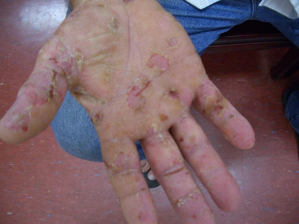 手のひらが爛れて痒いのは鍼と漢方で著しく改善