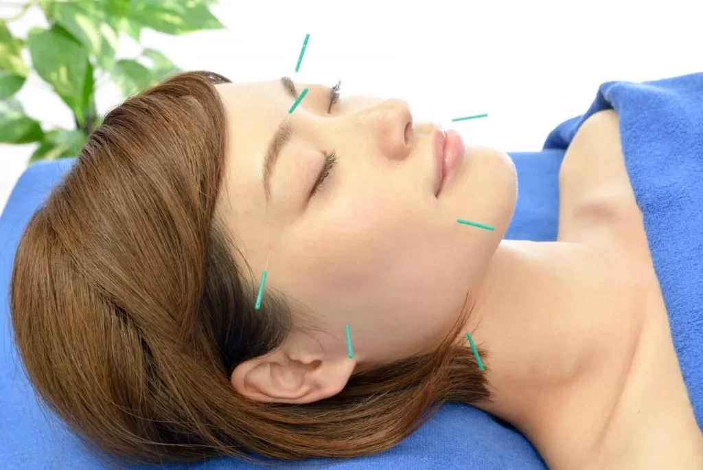 仰向けの女性の顔に刺した美容鍼