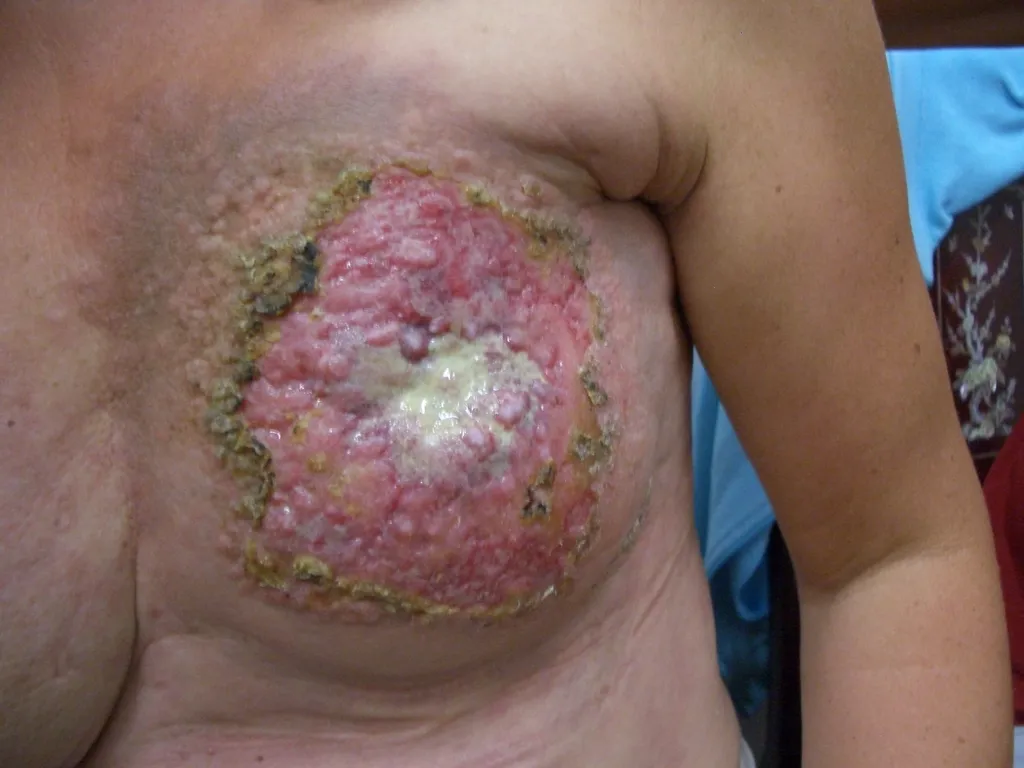 乳がん手術・放射線治療後の左胸皮膚 – 重度の炎症、黄色い縁と浸出液、赤くブツブツした損傷（閲覧注意）