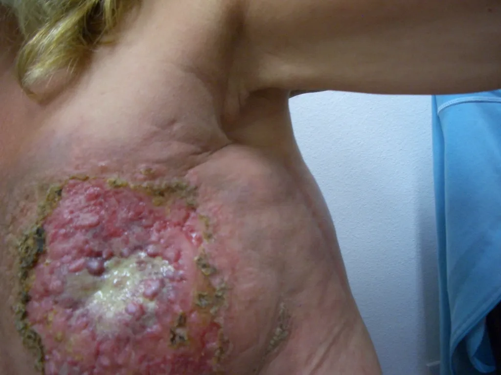 乳がん手術・放射線治療後の左胸皮膚 – 重度の炎症、黄色い縁と膿、赤くブツブツした火傷のような損傷（閲覧注意）