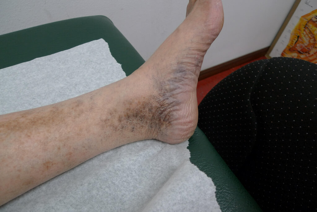 心臓疾患で喘息・静脈瘤が起きたおじいちゃん。牛乳で乳がんになった70代のおばあちゃん。