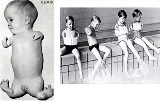 サリドマイド薬害被害児の白黒写真。左：手足が短く欠損した子供、右：プールサイドに座る手のない4人の子供たち