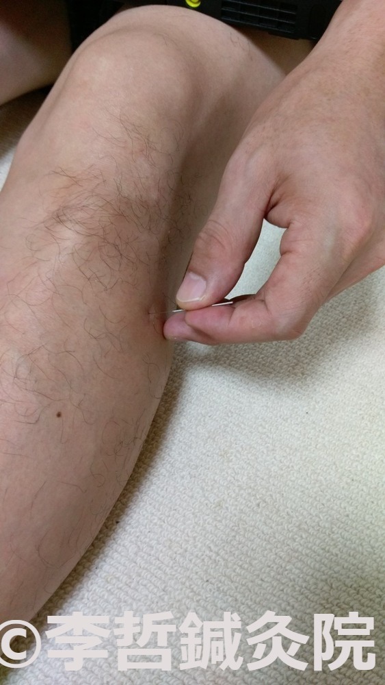 陽陵泉穴に鍼を刺した足のクローズアップ画像