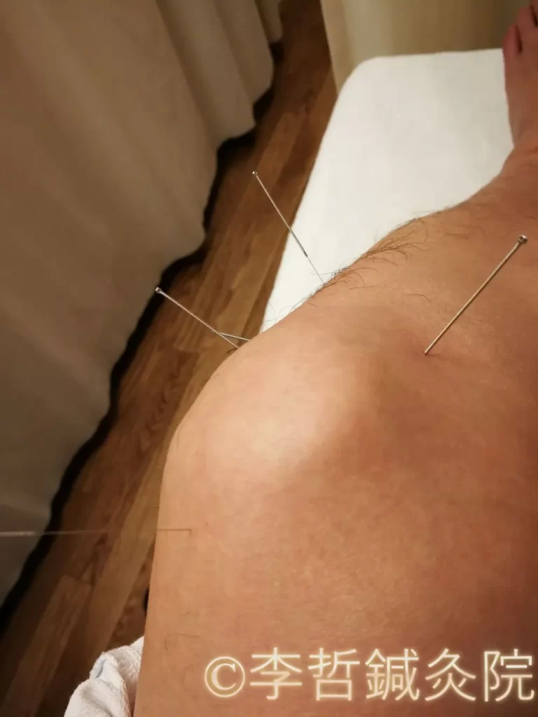 膝の痛みを治療する膝五鍼（鶴頂、陰陵泉、陽陵泉、内膝眼、外膝眼）と足三里のツボに刺した鍼の施術画像。効果的な鍼灸治療例。