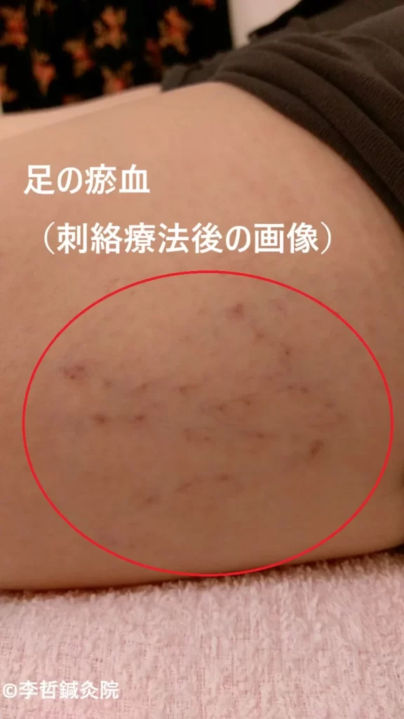 右太もも側面の瘀血。刺絡療法後に青紫色の異常血管を赤丸で囲んだ画像。