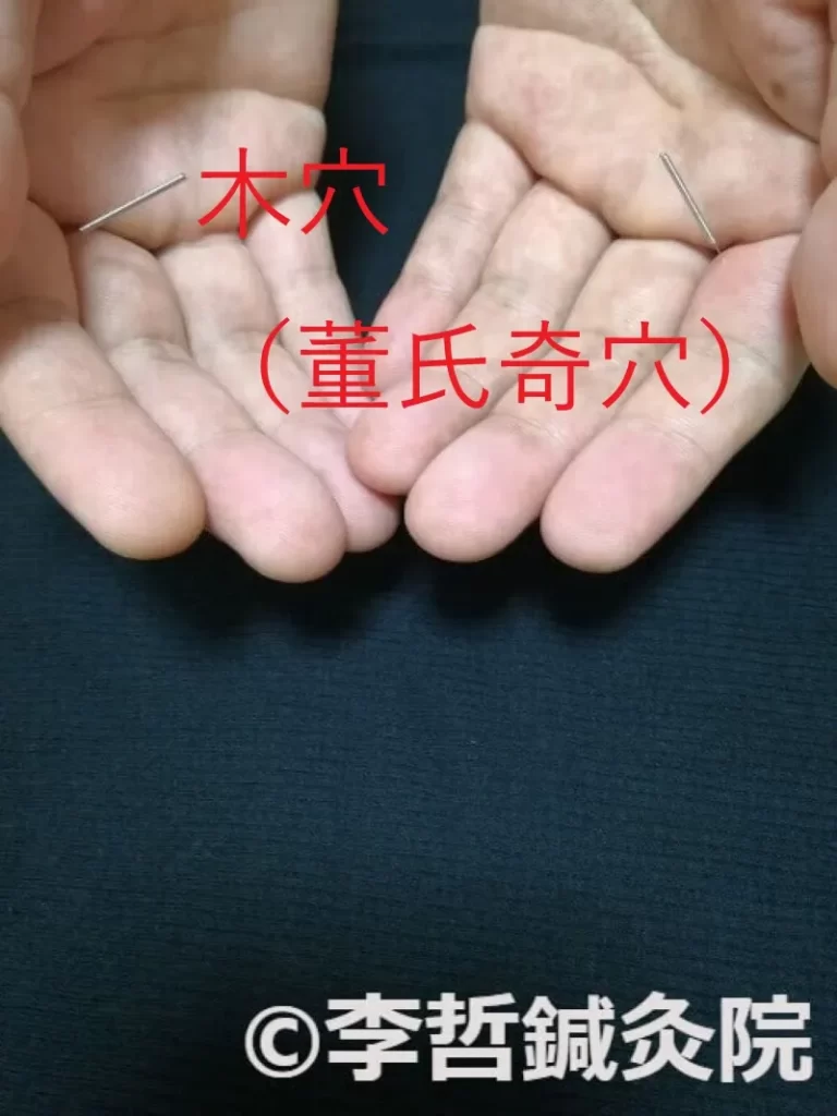 手のひらの董氏奇穴・木穴に鍼を刺した写真。赤文字で木穴と表示されている。