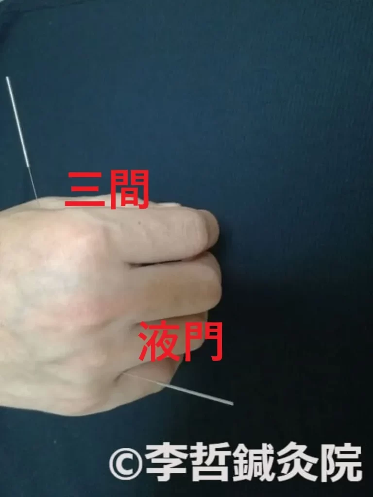 三間と液門に刺した鍼の写真。赤文字でツボ名が表示されている。