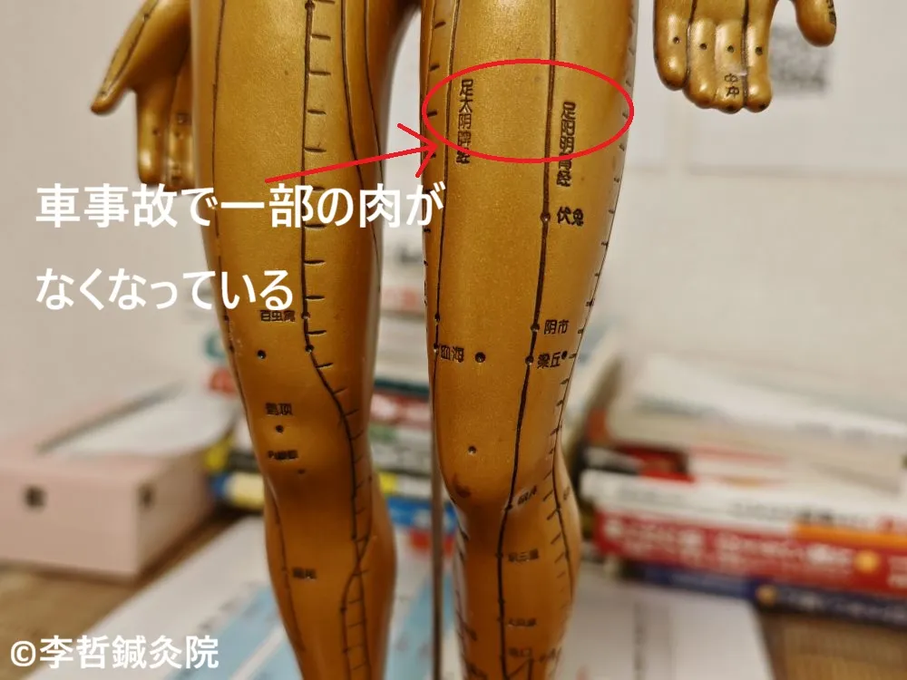 車事故後の左大腿部。肉が一部なくなって凹んでいる部分を赤丸で示したツボ人形の模型。