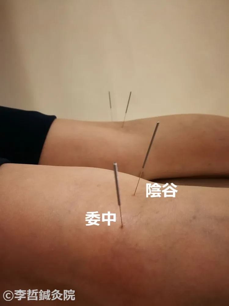 膝裏の委中穴と陰谷穴に鍼を刺した写真｜腰痛・膝痛に効くツボ