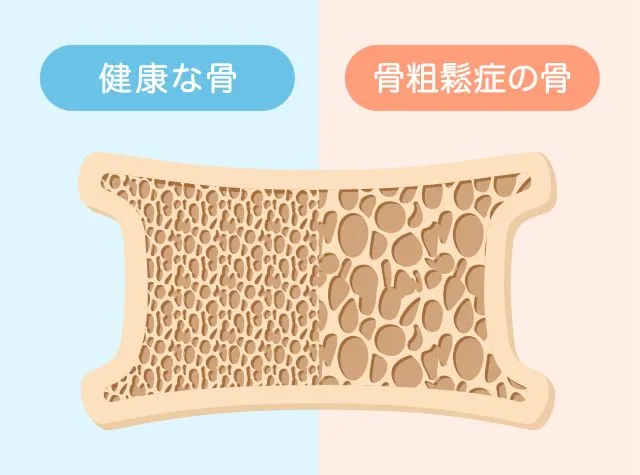 左側が健康な骨、右側が骨粗鬆症でスカスカになった骨の比較イラスト