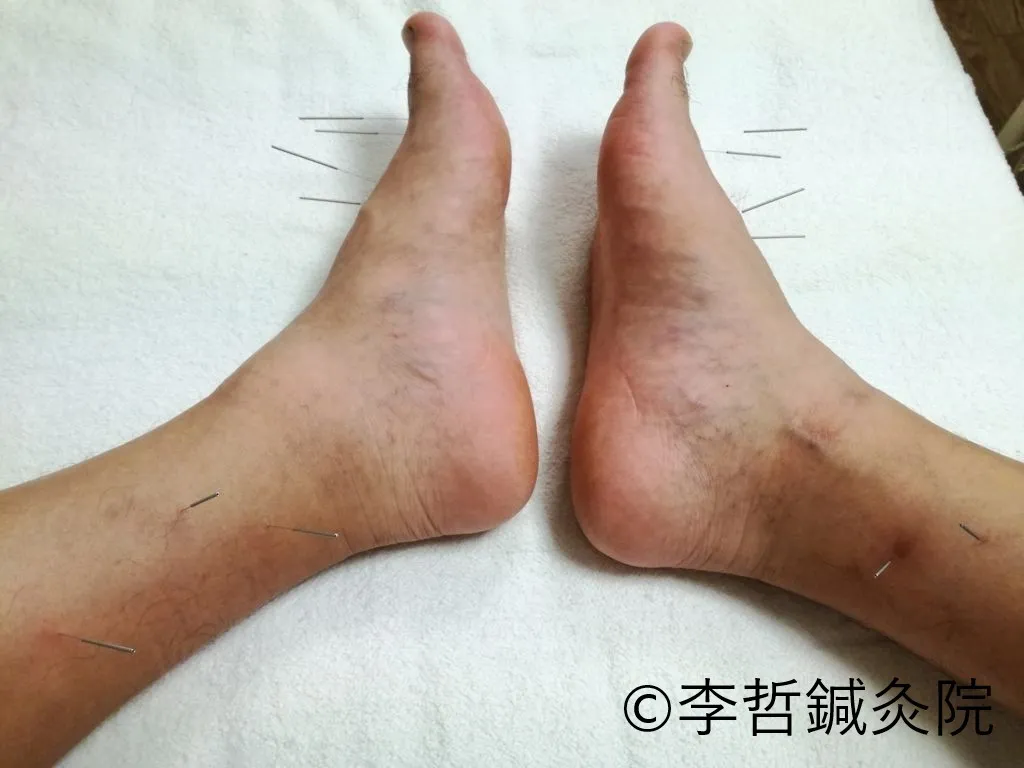 結節性紅斑治療で使用したツボ(太衝・行間・陥谷・内廷・三陰交・築賓)