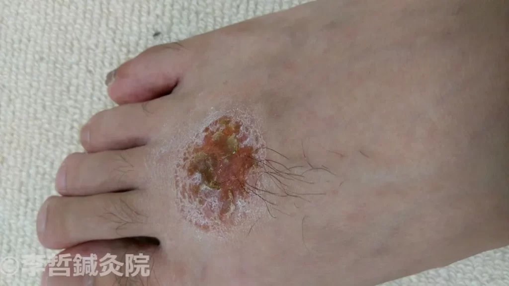 足の甲にできた円形の結節性紅斑、黄色い浸出液が大量に出て痒い状態(2016.8.16)