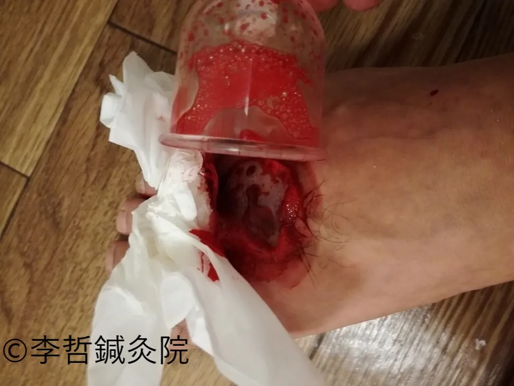 刺絡療法で大量の黒い瘀血と毒素が出て痒みが一気に落ち着いた瞬間(2016.9.10)