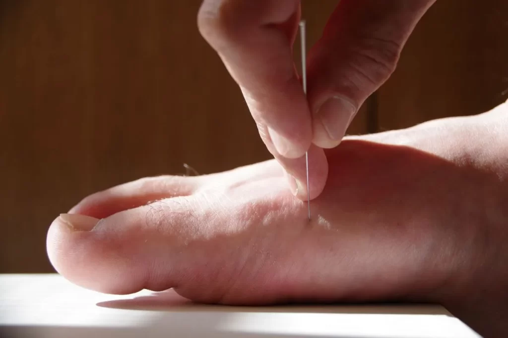 李哲先生自身の足の公孫穴に鍼を刺す直前の写真