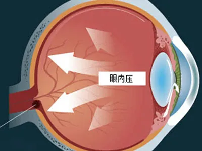 眼内圧亢進を示す目の組織のイラスト。眼球の断面図に「眼内圧」の文字が記載され、緑内障に関連する眼圧の上昇を視覚的に表現。