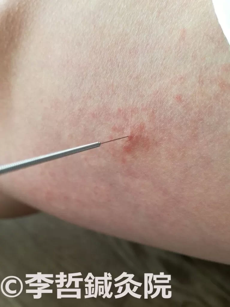 乾燥肌のかゆみとブツブツを治療するため、右太ももの血海穴に刺した鍼の画像