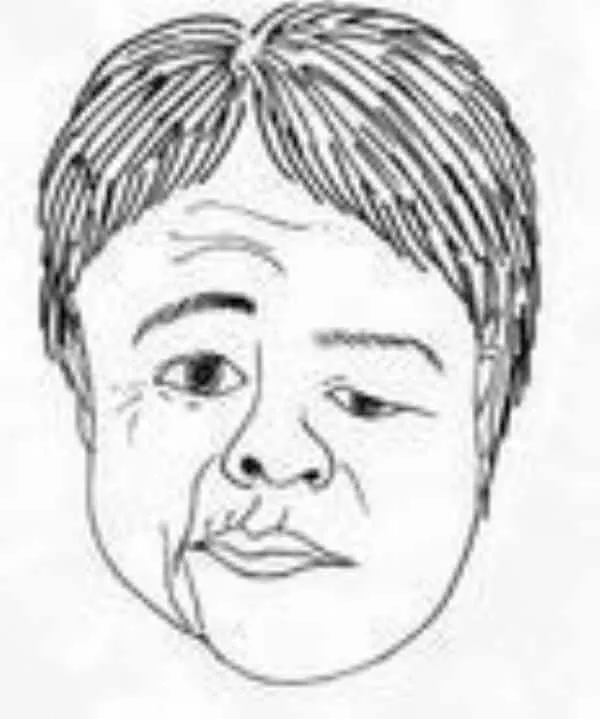 顔の歪みを鍼灸で治療する男性のイラスト。顔面神経麻痺の改善例を表現。