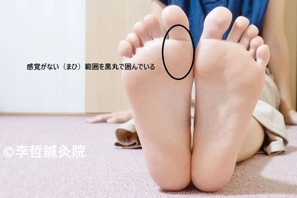 右足の親指の裏側に感覚がない範囲を黒丸で囲った写真。黒文字で「感覚がない（まひ）範囲を黒丸で囲んでいる」と記載