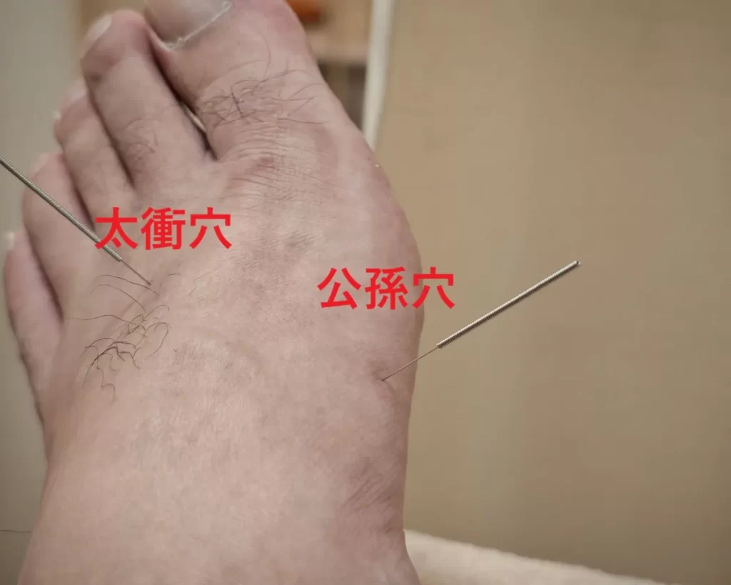 足に鍼を刺した再現写真。赤文字で「太衝（肝経）」と「公孫（脾経）」を表示。末期乳がんの吐き気・心臓痛・内臓痛を劇的に改善した最重要ツボ
