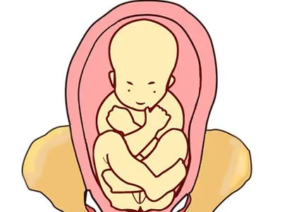 ピンクの子宮内で逆子になった赤ちゃんのイラスト - 鍼1回で安産に導く