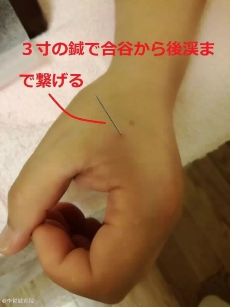 左手の合谷から後渓まで3寸の鍼でつなげた刺鍼の様子。赤文字で説明入り。