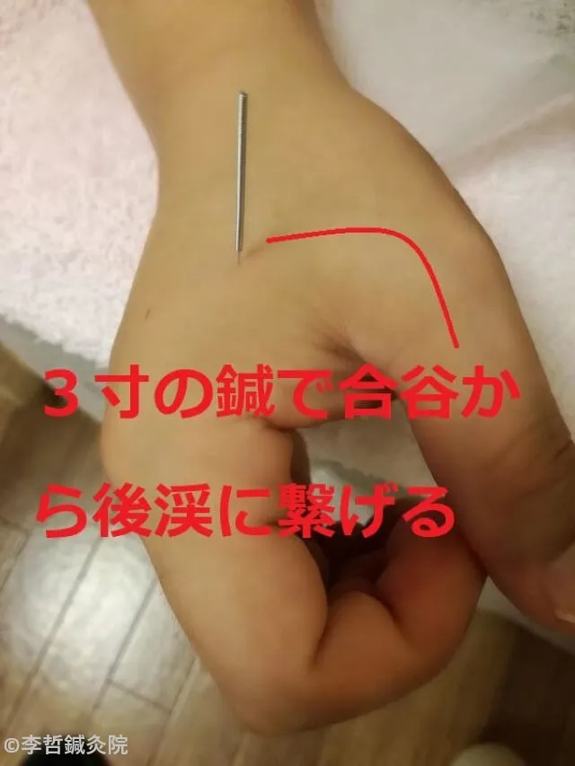 右手の合谷から後渓まで3寸の鍼でつなげた刺鍼。赤文字で説明入り。