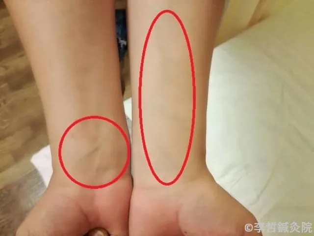 鍼治療後、両腕の内側の血管が浮き上がった部分を赤丸で示した画像。