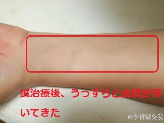 鍼治療後、左腕の内側で血管がうっすら浮き上がった部分を赤枠で囲んだ画像。