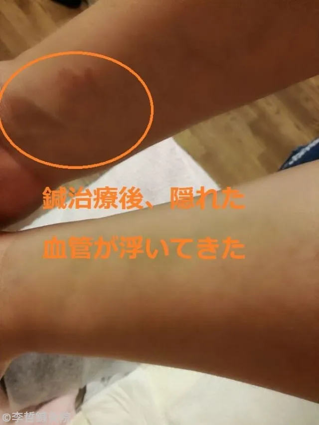 鍼治療後、両腕の内側の隠れていた血管が浮き上がった様子。オレンジ文字で説明入り。