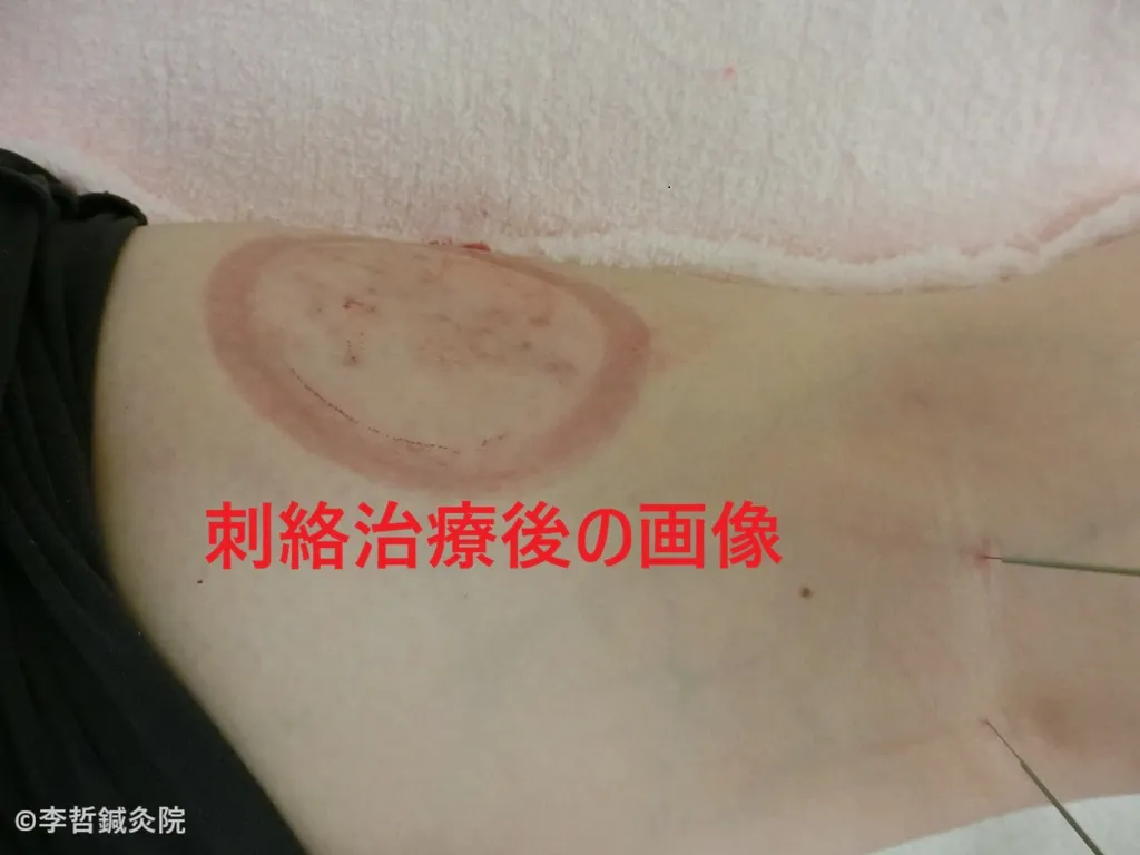 右膝後ろの上部に刺絡療法を行った後の画像。瘀血を排出したあとの様子