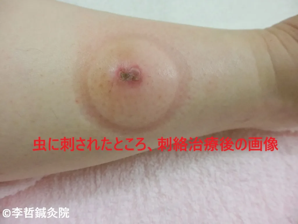 虫刺されの腫れた部分に刺絡療法を行った後の画像。毒素と瘀血を排出