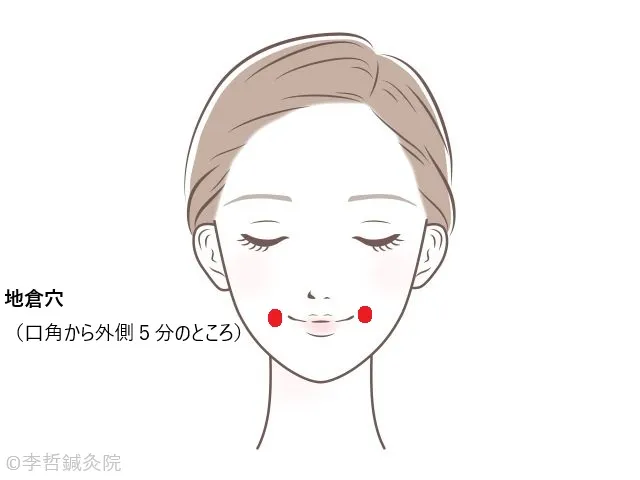 女性の顔イラストで、口角外側に赤丸で地倉穴を標記。「地倉穴(口角から外側5分のところ)」と文字入り。川崎病の口角裂け改善に使用。