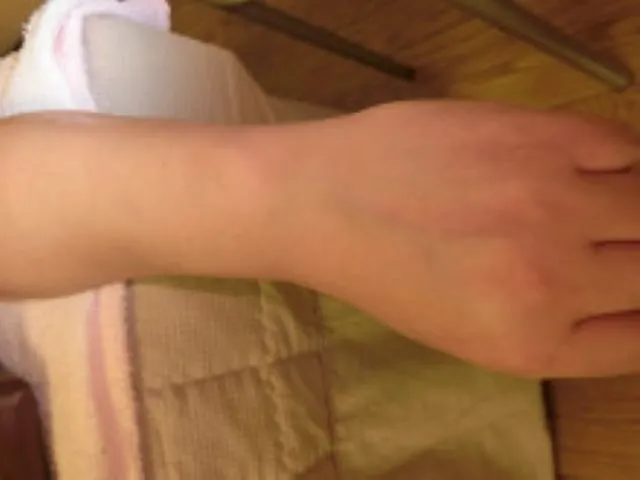 鍼治療前の手と腕の外側を撮影した写真。血管が細く、表面にほとんど浮き出ていない。