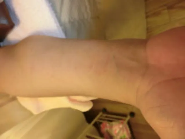 鍼治療前の手と前腕の内側を撮影した写真。血流が悪く、青い静脈が細くほとんど見えない状態。