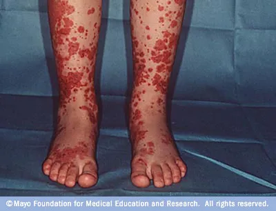 アレルギー性紫斑病（HSP）の典型的な足の紫斑・赤紫色の出血斑クローズアップ