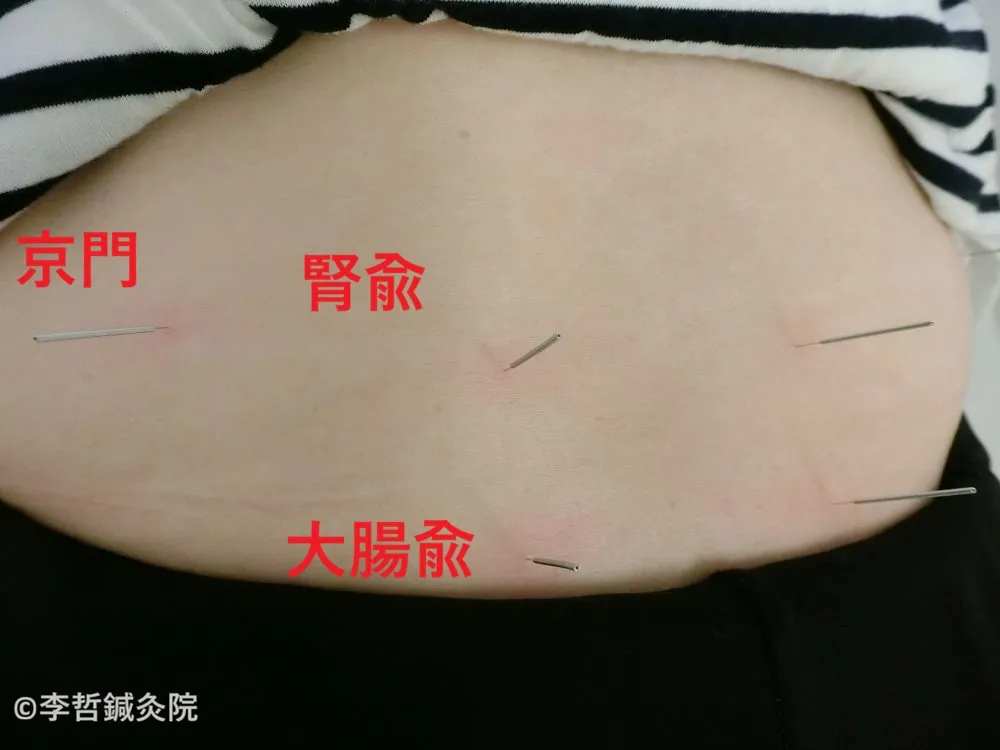 うつ伏せの患者の腰部に腎兪・大腸兪・京門へ刺した鍼。鍼の周囲がピンク色に反応し、強い得気が出ている様子。