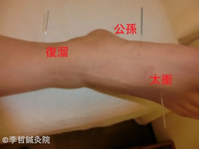 公孫・太衝・復溜に鍼を刺した施術写真。鍼の横にツボ名が記載され、足の甲と内側が上から見える角度で撮影されている。