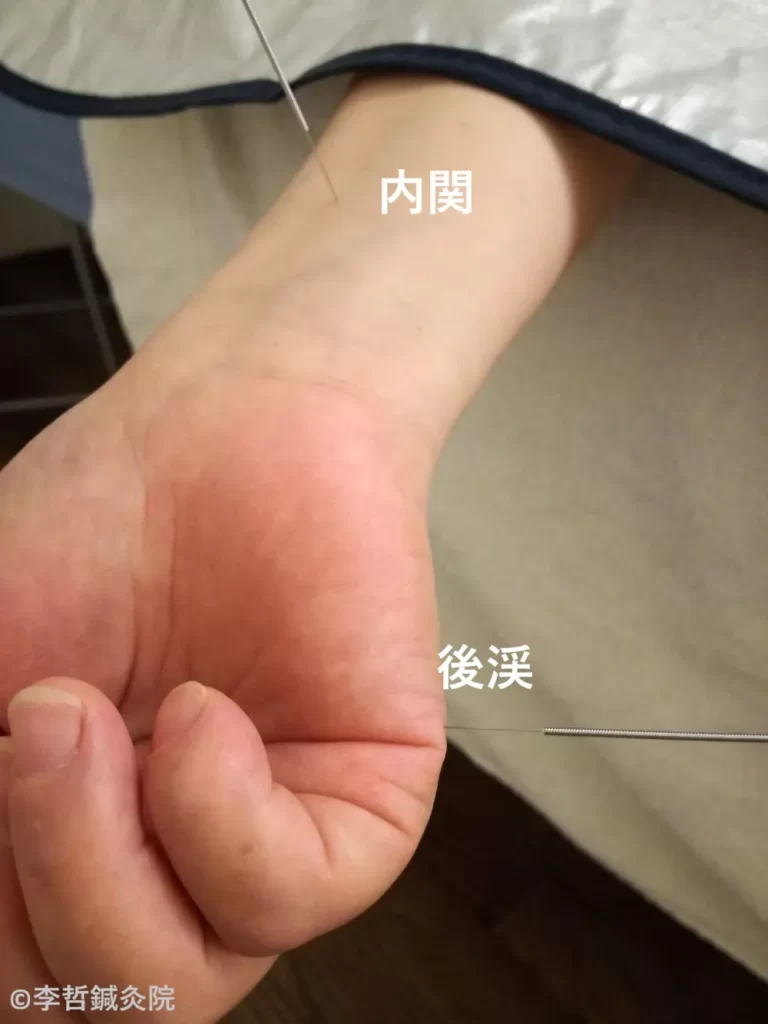後渓穴と内関に鍼を刺した施術写真。顔半分の痛みや寝違えに効果があるツボ。