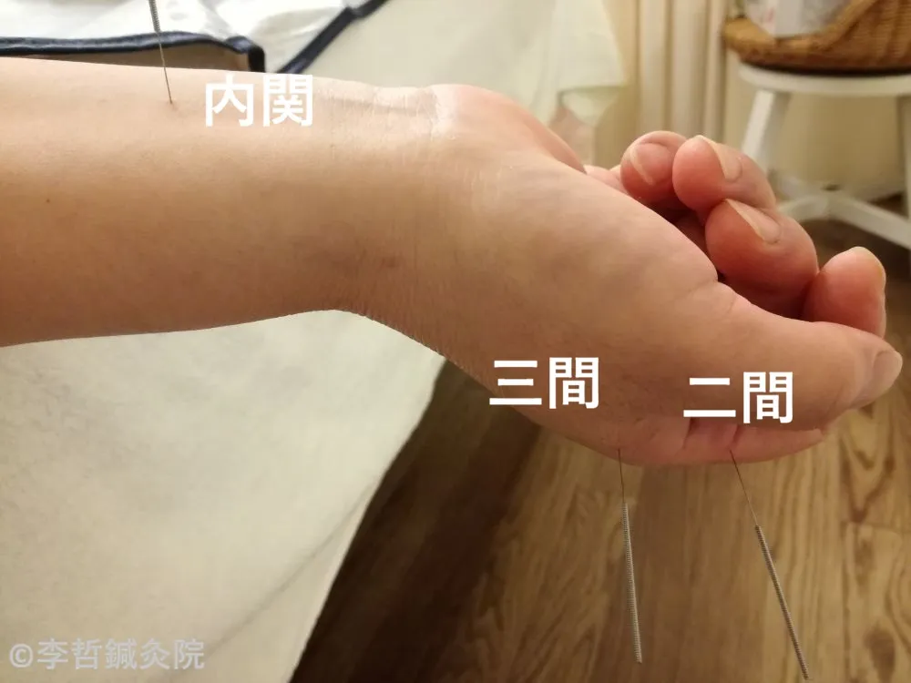 内関・三間・二間に鍼を刺した施術写真。顔半分の痛みや奥歯の痛みに使う遠隔のツボ。