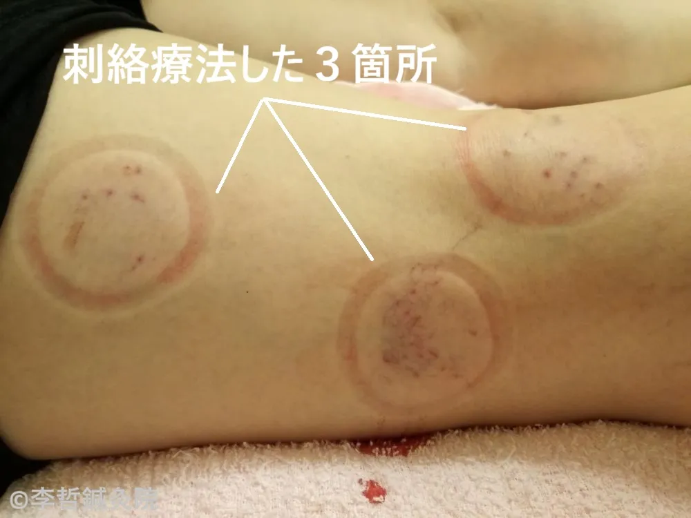 左膝裏の刺絡療法の施術写真。3箇所の刺絡ポイントを示した画像。