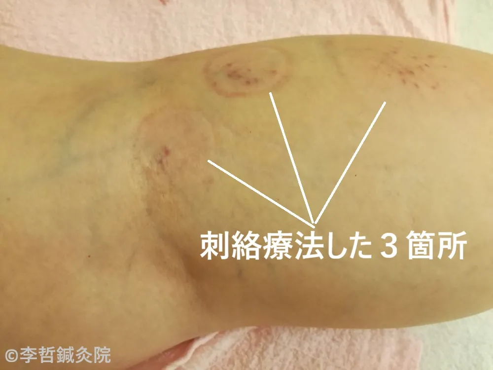 右膝裏の刺絡療法の施術写真。3箇所の刺絡ポイントを示した画像。