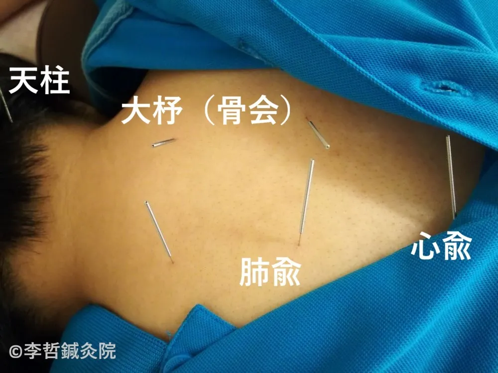 天柱・大杼・肺兪・心兪に鍼を刺した施術写真。肩こり、皮膚の痒み、睡眠改善に使うツボ。