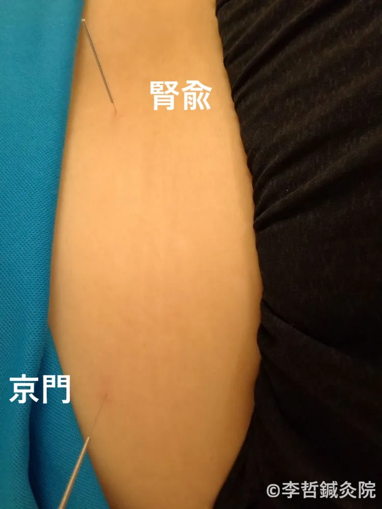 腎兪と京門に鍼を刺した施術写真。腰痛や顔の痛みに関連するツボの位置がわかる画像。