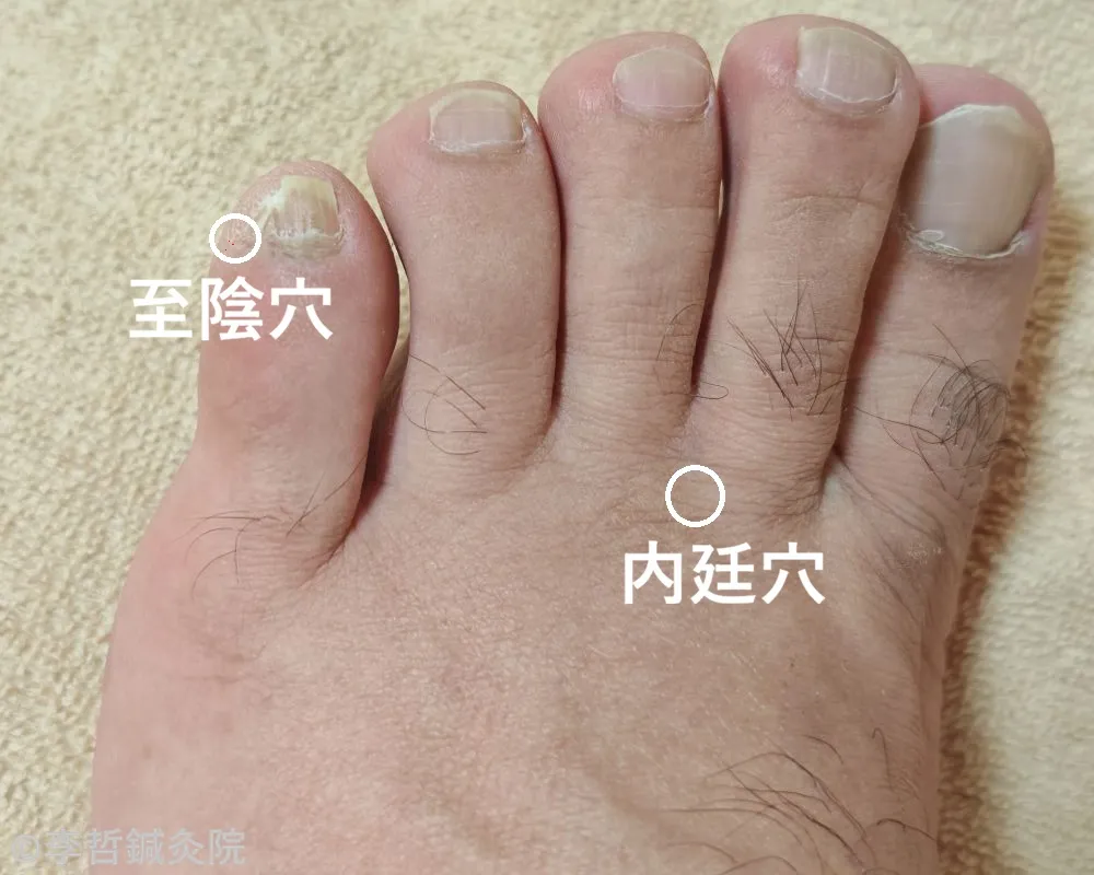 左足の内廷穴と至陰穴に白丸で印をつけ、隣に白文字でツボ名を表示した写真