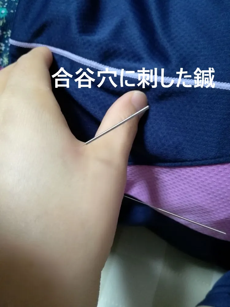 合谷穴（手の甲）に鍼を刺しているところ。「合谷穴に刺した鍼」と文字入り